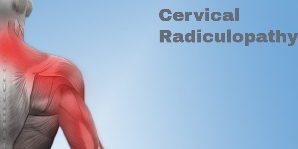 Cervical Radiculopathy Symptoms Treatments Legacy Spine