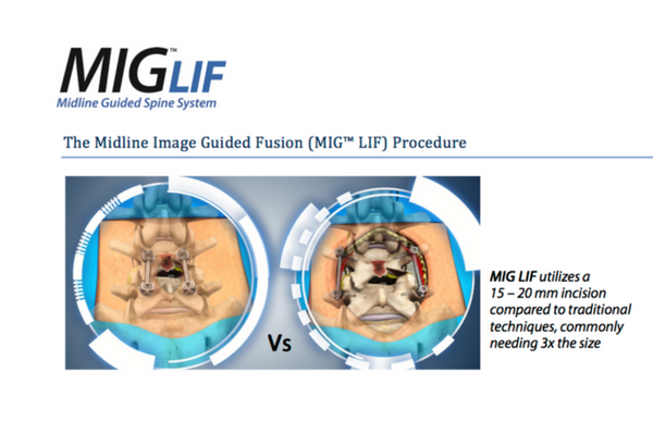 The MIG-LIF Procedure
