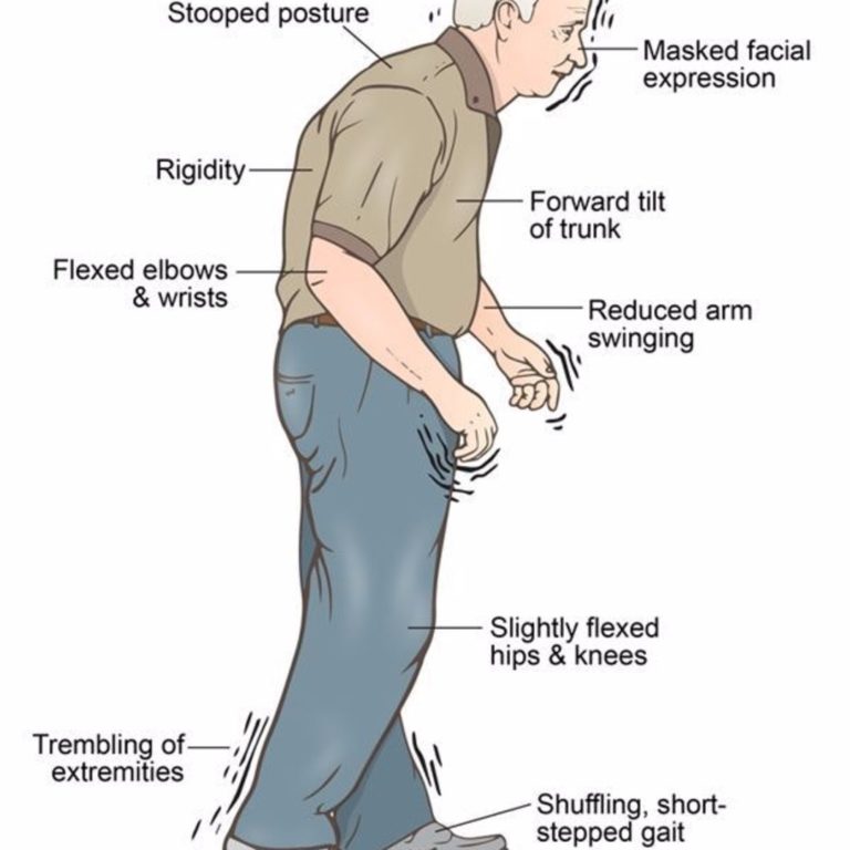 Parkinson's Disease as related to Neurologic Diseases (General) - Pictures