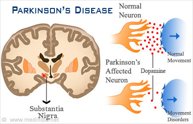 Dopamine & Parkinson's Disease: The Link Between