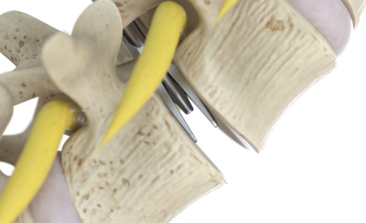 s-lif spinal surgery for pain relief