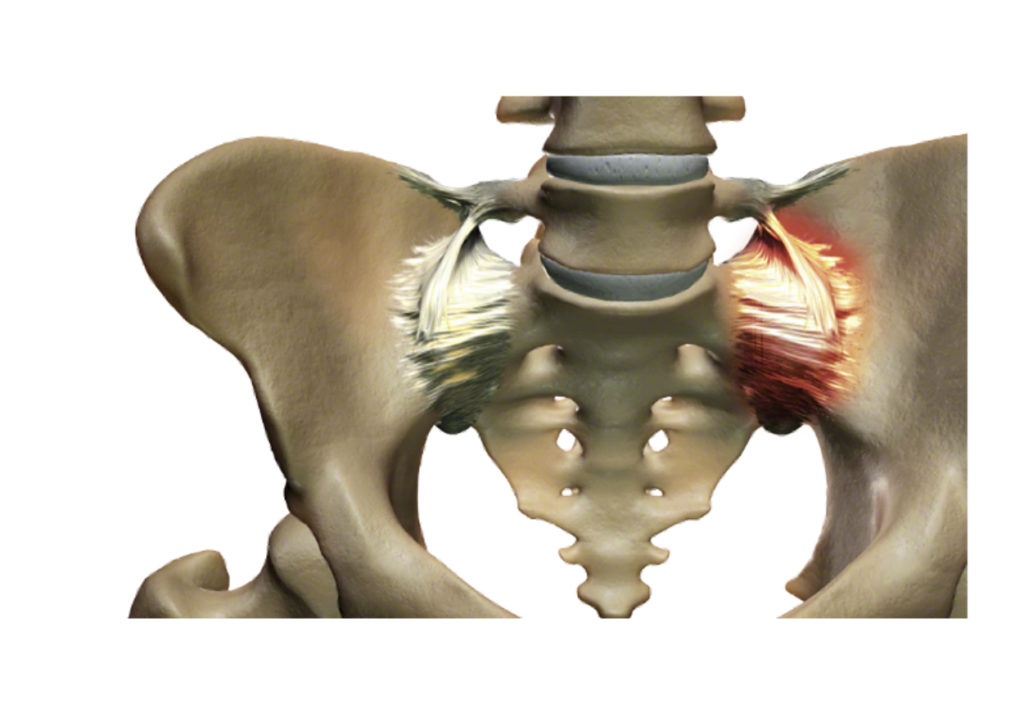 SI-Joint ᴺᴱᵂ - Legacy Spine & Neurological Specialists